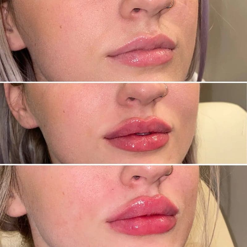 Preenchimento Labial Kisse Galderma