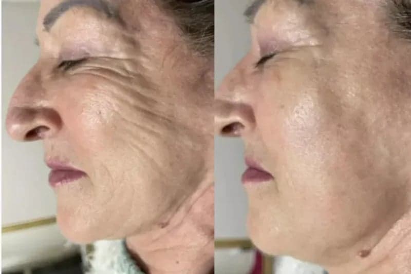 Endolaser + Bioestimulador + Ultraformer