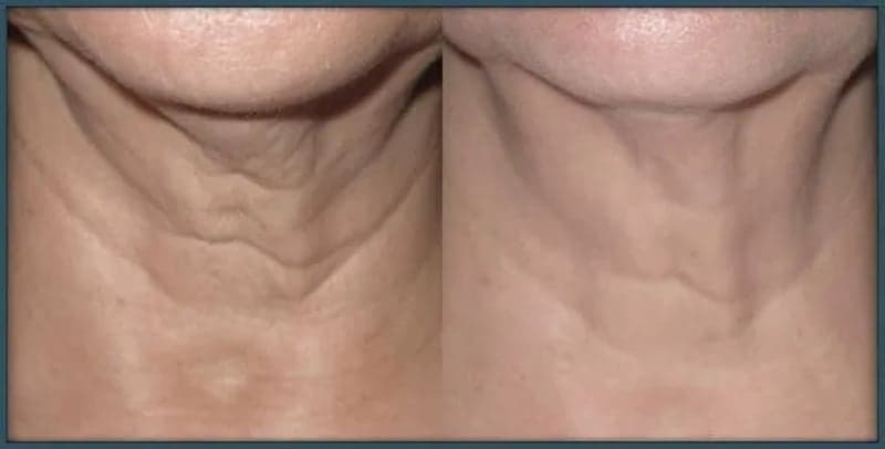 Skin Lifting Candela